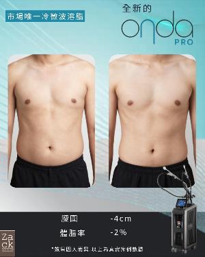 OndaPro冷微波溶脂療程-體驗