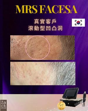 Derma Roller微针重塑疗程-体验价