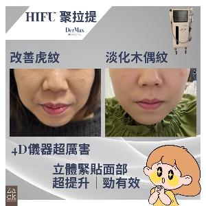 DerMax Hifu 面部提拉療程-體驗價